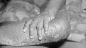 Read more about the article MONKEYPOX : first case was detected in U.S